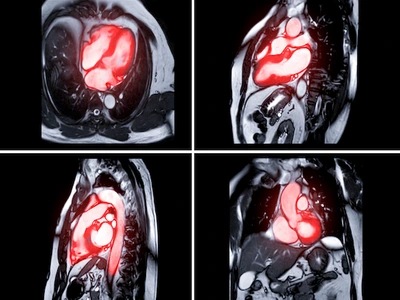 CARDIAC MRI AND CONSULTATION